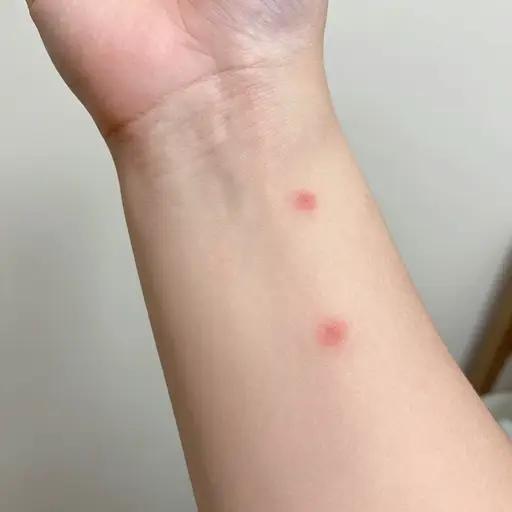 昨晚我被蚊子咬了好几个包。