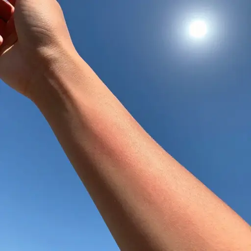 在太阳下待了一天，我的皮肤感觉很不舒服地干燥。