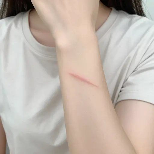 事故在她手臂上留下了一个难看的疤痕。