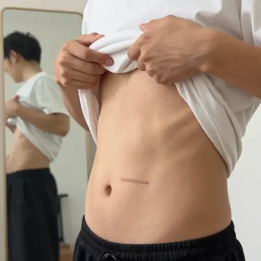 他的肚脐旁边有一道小疤。