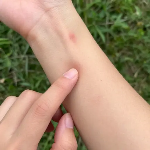 不要挠你的蚊子包！