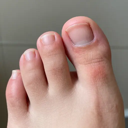 他的脚趾在受伤后感染了。