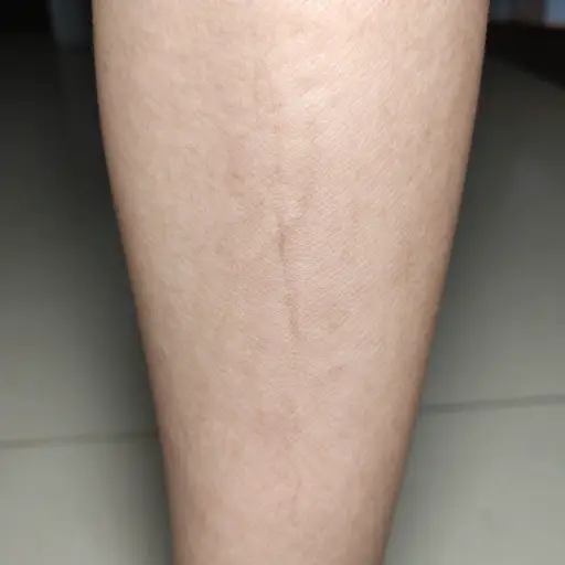 腿部的静脉有时会肿胀。