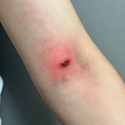 伤口感染了。