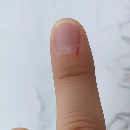 我手指上有个小伤口。